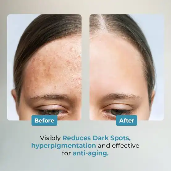 How Can Pure Ferulic Acid Powder Reduce Hyperpigmentation Effectively?